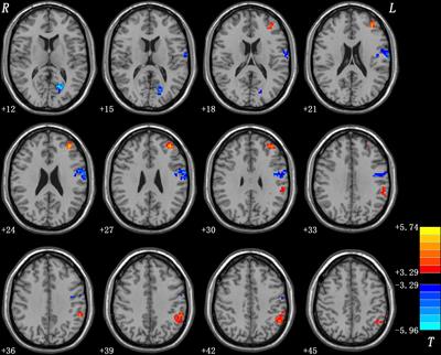 Altered Global Brain Functional Connectivity in Drug-Naive Patients With Obsessive-Compulsive Disorder